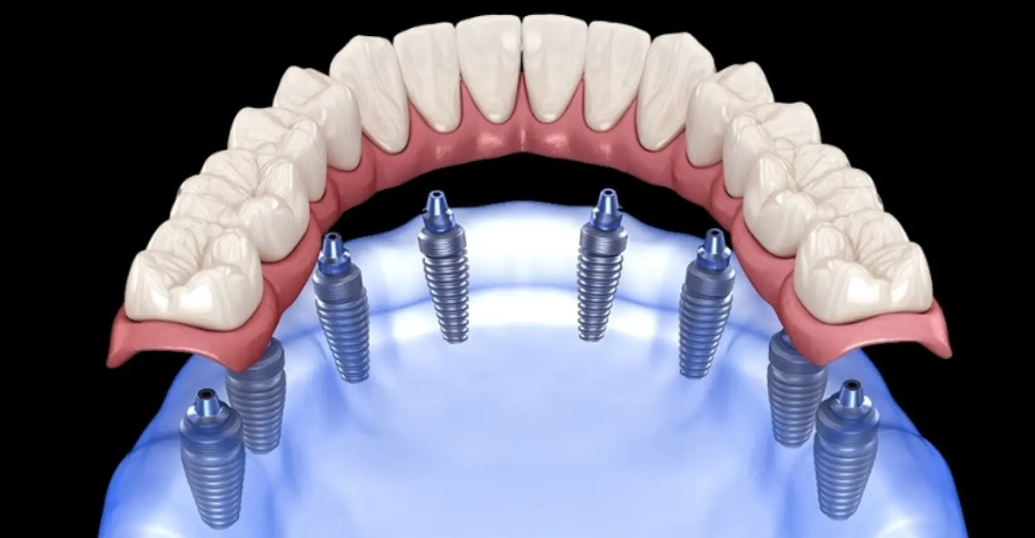 All on 8 Dental Implants Cost 2